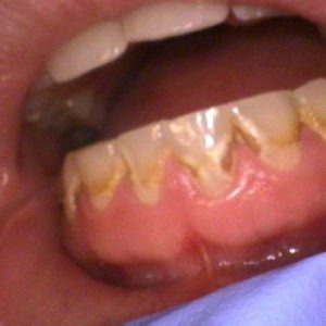 Teeth with Tartar and Plaque - Before Treatment | Alluring Smiles in Mesa, AZ - Dr. Javier Portocarrero