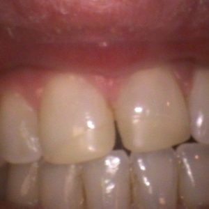 Smile Gallery Before 8 | Alluring Smiles - Mesa, AZ Dentist