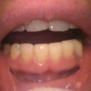Smile Gallery After 3 | Alluring Smiles - Mesa, AZ Dentist