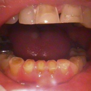 Smile Gallery Before 2 | Alluring Smiles - Mesa, AZ Dentist