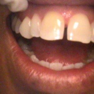 Gapped in Upper Middle Teeth - Before Treatment | Alluring Smiles in Mesa, AZ - Dr. Javier Portocarrero