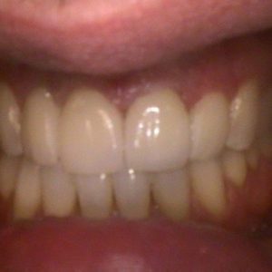 Smile Gallery After 8 | Alluring Smiles - Mesa, AZ Dentist