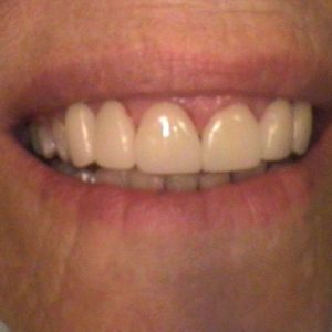 Smile Gallery After 7 | Alluring Smiles - Mesa, AZ Dentist