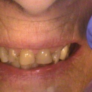Smile Gallery Before 6 | Alluring Smiles - Mesa, AZ Dentist