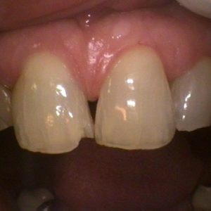 Worn Teeth - Before Treatment | Alluring Smiles in Mesa, AZ - Dr. Javier Portocarrero