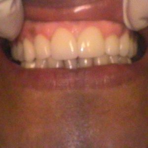 Restored Worn Teeth - After Treatment | Alluring Smiles in Mesa, AZ - Dr. Javier Portocarrero