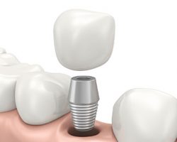 Dental Implants Parts | Alluring Smiles in Mesa, AZ - Dr. Javier Portocarrero